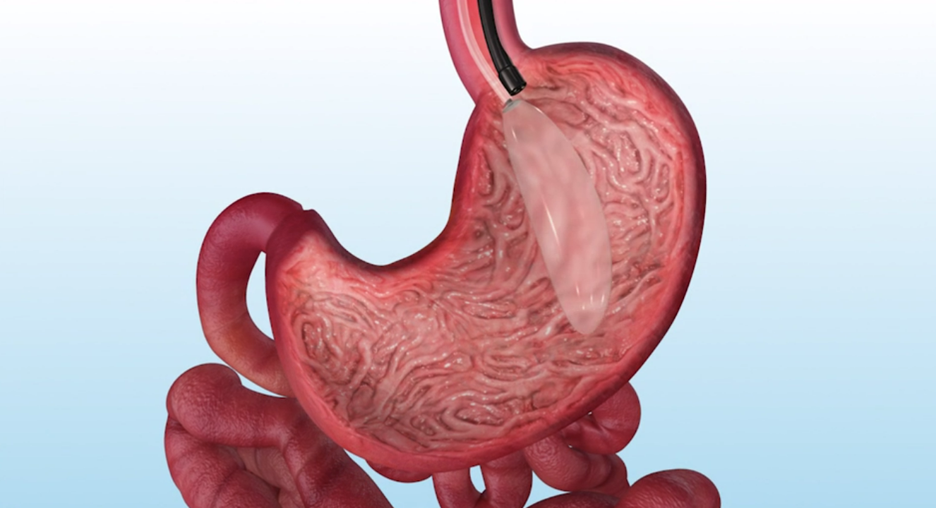 A close up of a person 's stomach with a tube coming out of it.