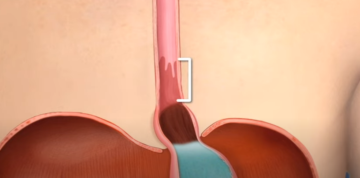A computer generated image of a person 's esophagus and stomach.