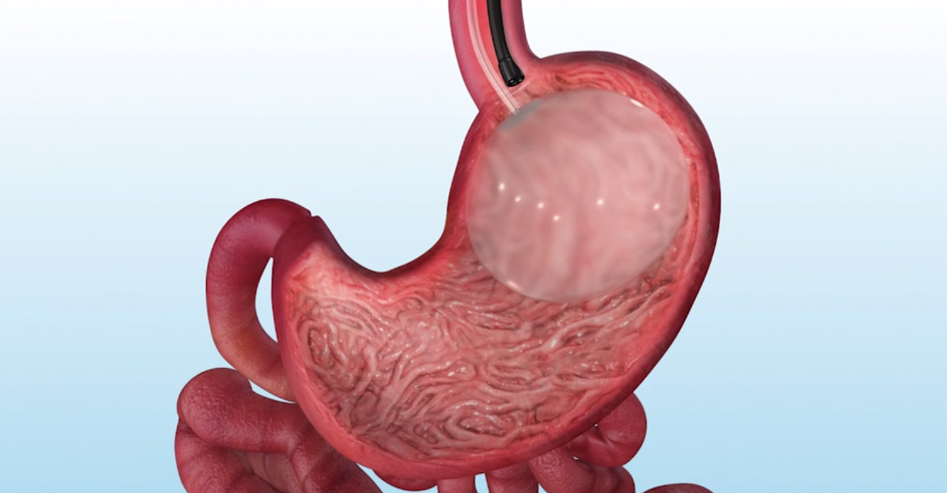 A computer generated image of a stomach with a balloon in it.
