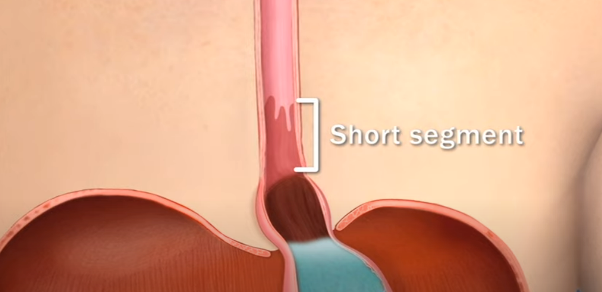 A computer generated image of a person 's esophagus with a short segment.