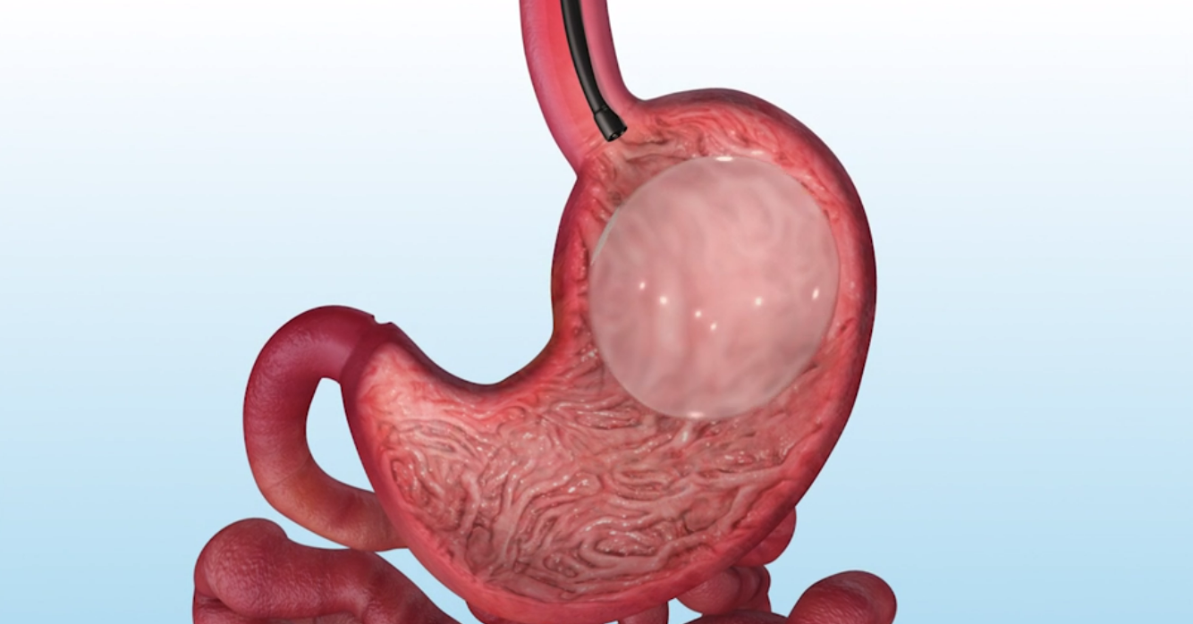A model of a stomach with a balloon in it.