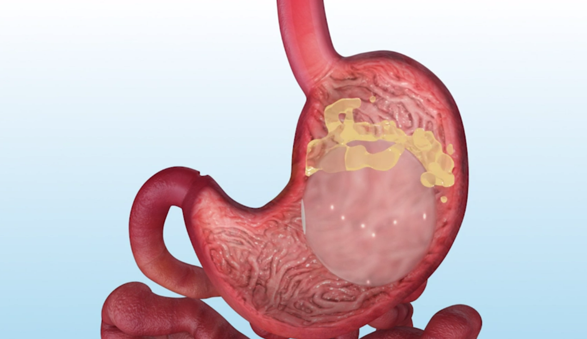 A model of a human stomach with a balloon in it.