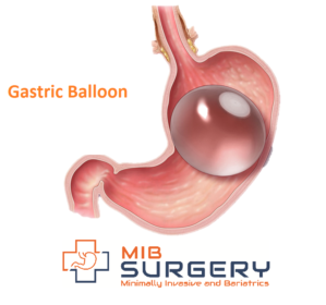 A stomach with a gastric balloon attached to it