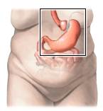An illustration of a woman 's stomach with a balloon attached to it.