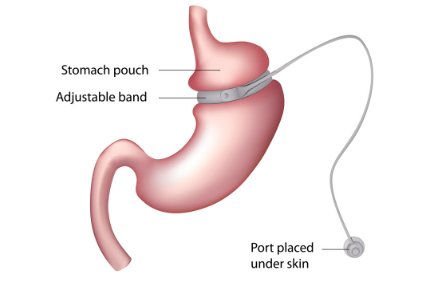A diagram of a stomach with an adjustable band attached to it