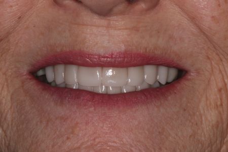 Close-up of a woman's smiling mouth, showcasing bright, white teeth and red lipstick.