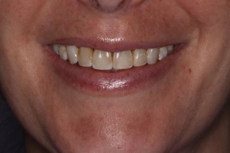 Close-up of a woman smiling, showing teeth and part of her face. Her skin is lightly tanned.