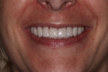Close-up of a woman smiling, revealing a full set of white, even teeth. Her lips are reddish-pink and her skin has freckles.