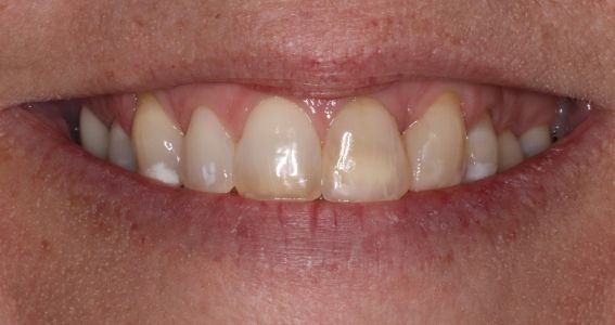 Close-up of a person's smile, showing yellowed teeth and pink gums.