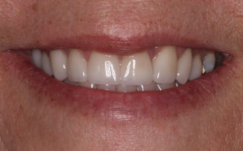 A close-up of a smiling person's mouth, showing bright white teeth and slightly reddish lips.