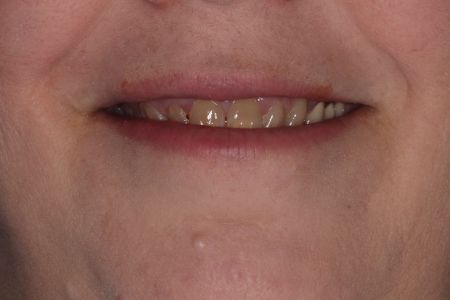 Close-up of a person's mouth, showing yellowish teeth. The lips are slightly parted in a smile.