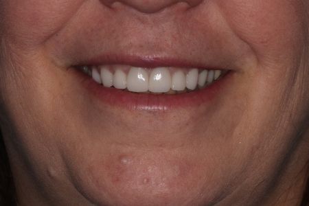 Close-up of a smiling woman's mouth and teeth. The teeth are white, and the lips are reddish-brown. There's visible skin texture.