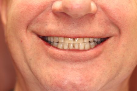 Close-up of a person smiling, showing teeth. Light skin tone, some yellowing on teeth, and slight wrinkling around the mouth.