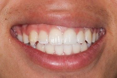 Close-up of a person smiling, showing white teeth and pink gums.