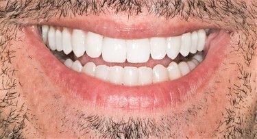 Close-up of a smiling man's mouth, showing a set of very white teeth and slightly pink lips, with stubble visible.