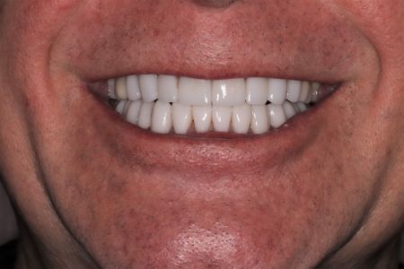 A person smiling, showing a full set of bright white teeth. The person has a fair complexion.