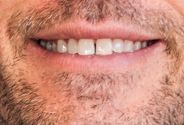 Close-up of a man's smiling mouth with a gap between the two front teeth, surrounded by a beard.
