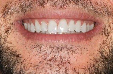 Close-up of a man's smiling mouth showing perfectly white, even teeth. He has a full beard and pink lips.