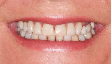 Close-up of a person's smile, showing a set of evenly spaced, white teeth framed by pink lips.
