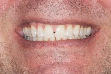 Close-up of a man's mouth showing teeth with a gap between the front teeth. He is smiling.