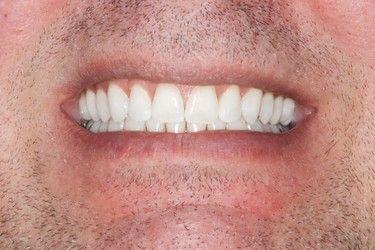 Close-up of a man's open mouth displaying a bright, white, even set of teeth. His lips and face are visible, with stubble.