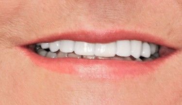 Close-up of a person smiling, showing a bright white, even set of teeth. Light pink lips.