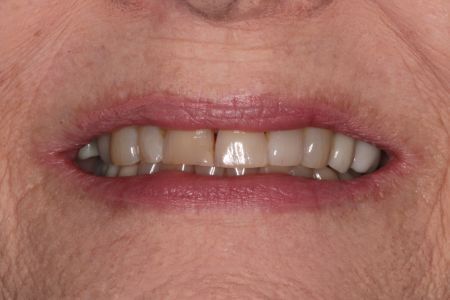 Close-up of a person's mouth showing teeth. The teeth are of varying shades, with a discolored front tooth.