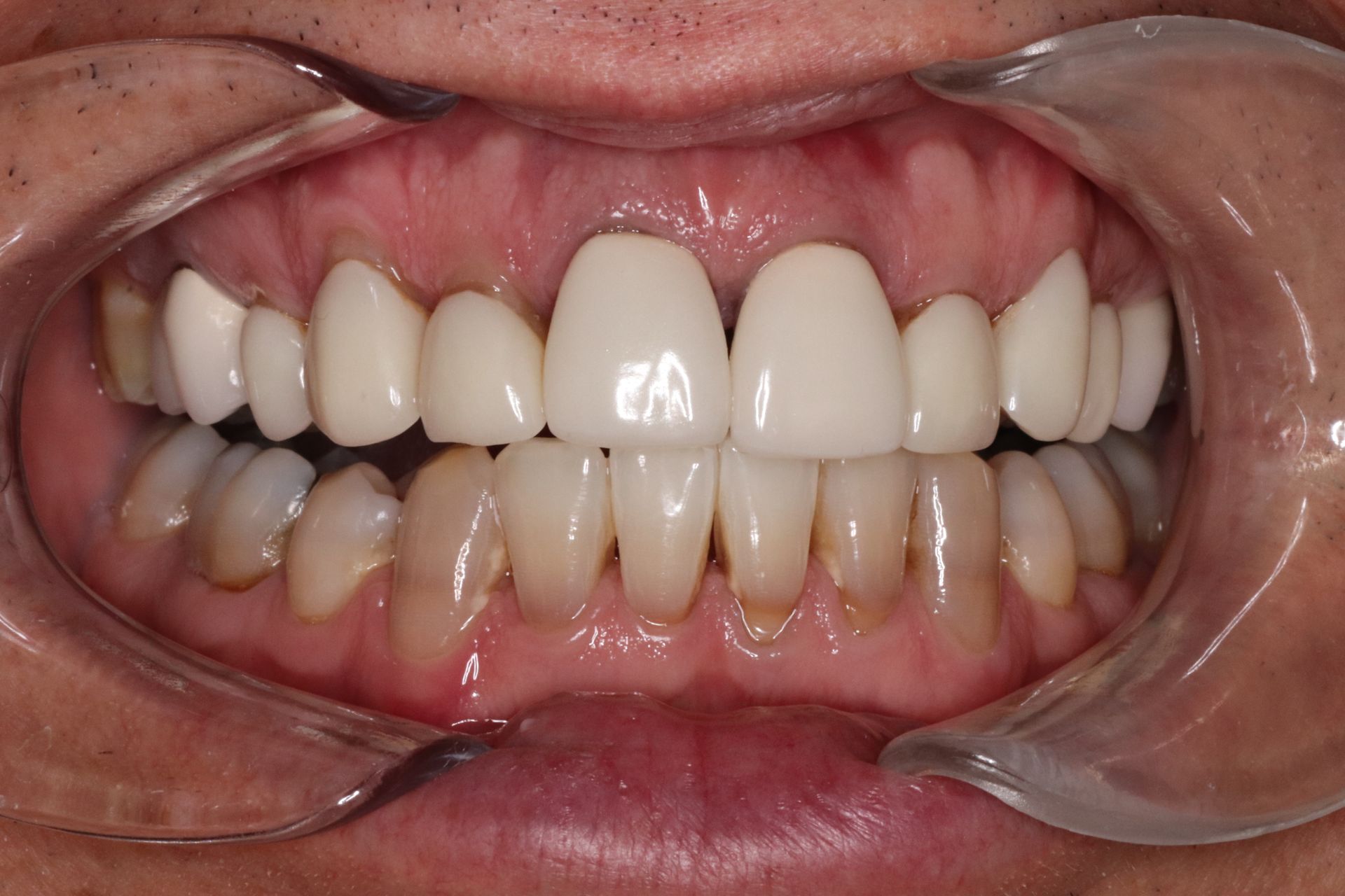 Close-up of a mouth showing teeth, with whiter front teeth and yellowing bottom teeth. A mouth retractor is in place.