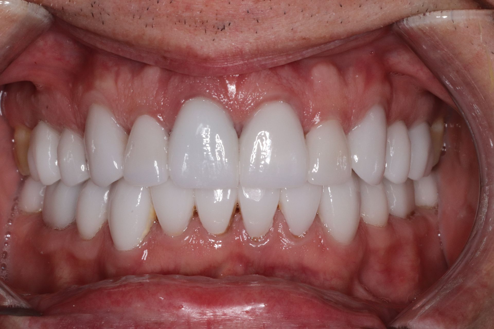 Close-up of a person's mouth showcasing a full set of bright, perfectly aligned, white teeth. Healthy gums and skin visible.