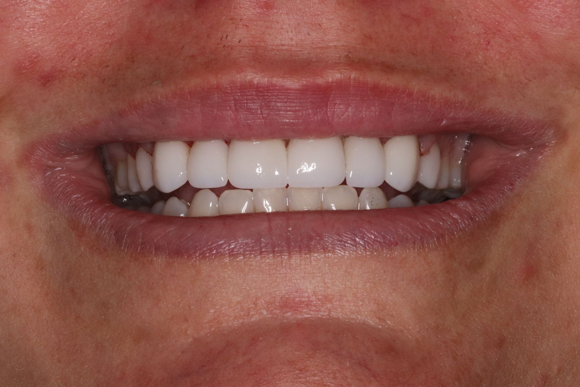 A person smiling, revealing a full set of bright, white teeth. Pink lips and surrounding skin are visible.