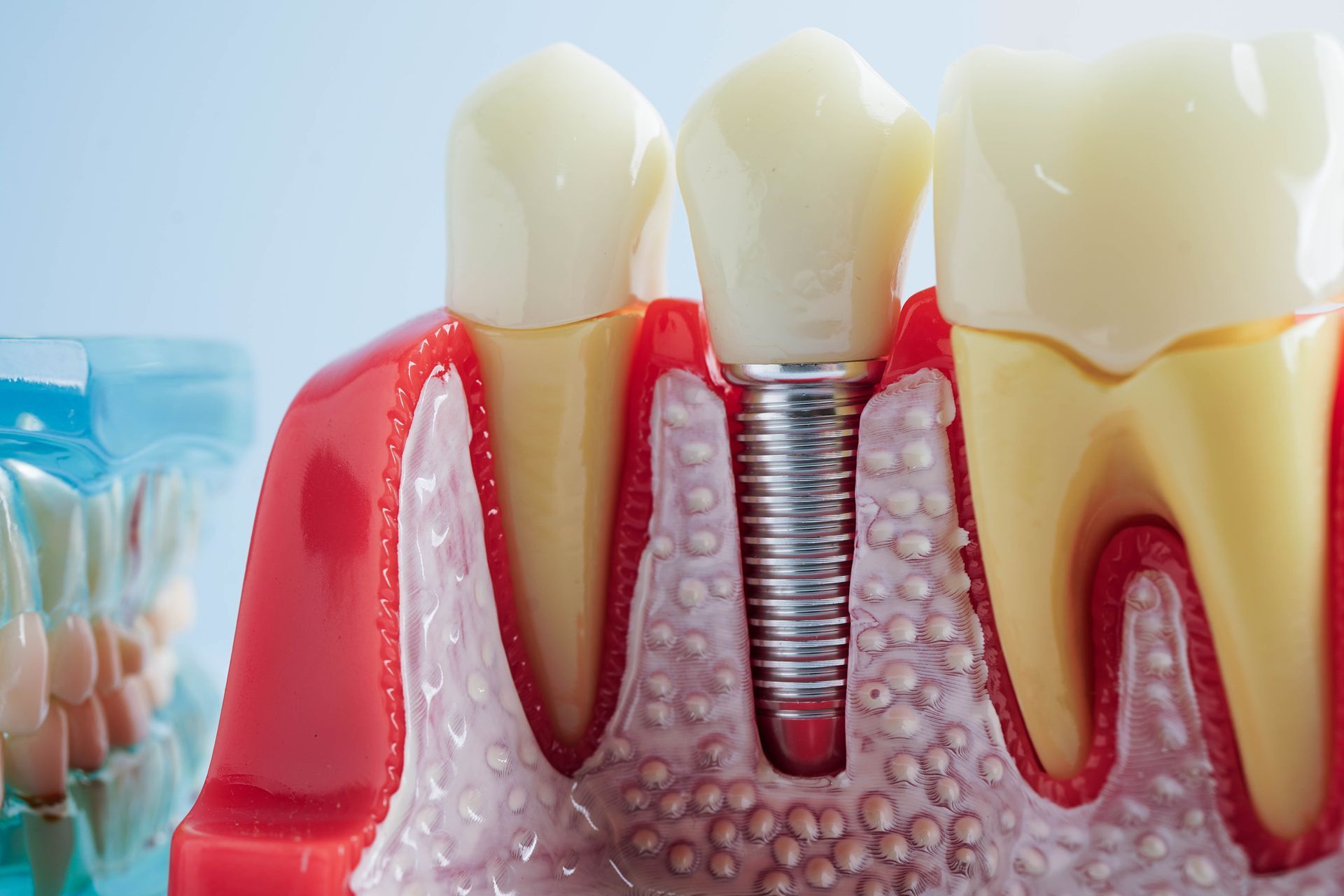 Model of teeth and gums showing a dental implant, with a metal screw fixture in the jaw and an attached tooth.