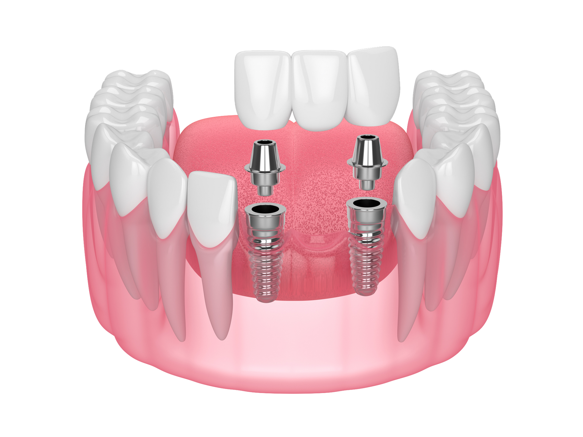 Implant-Supported Bridges