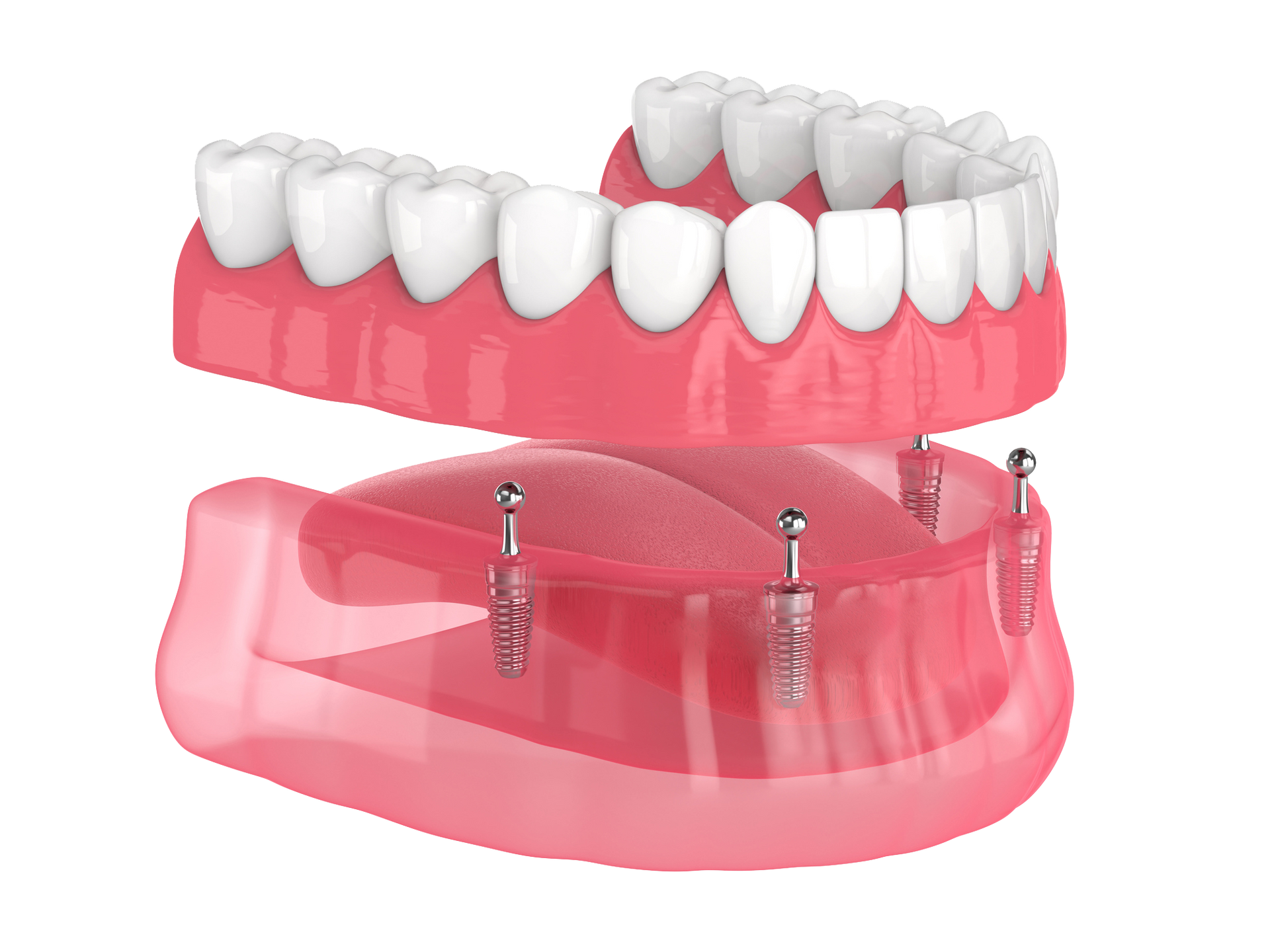 Implant-Supported Dentures