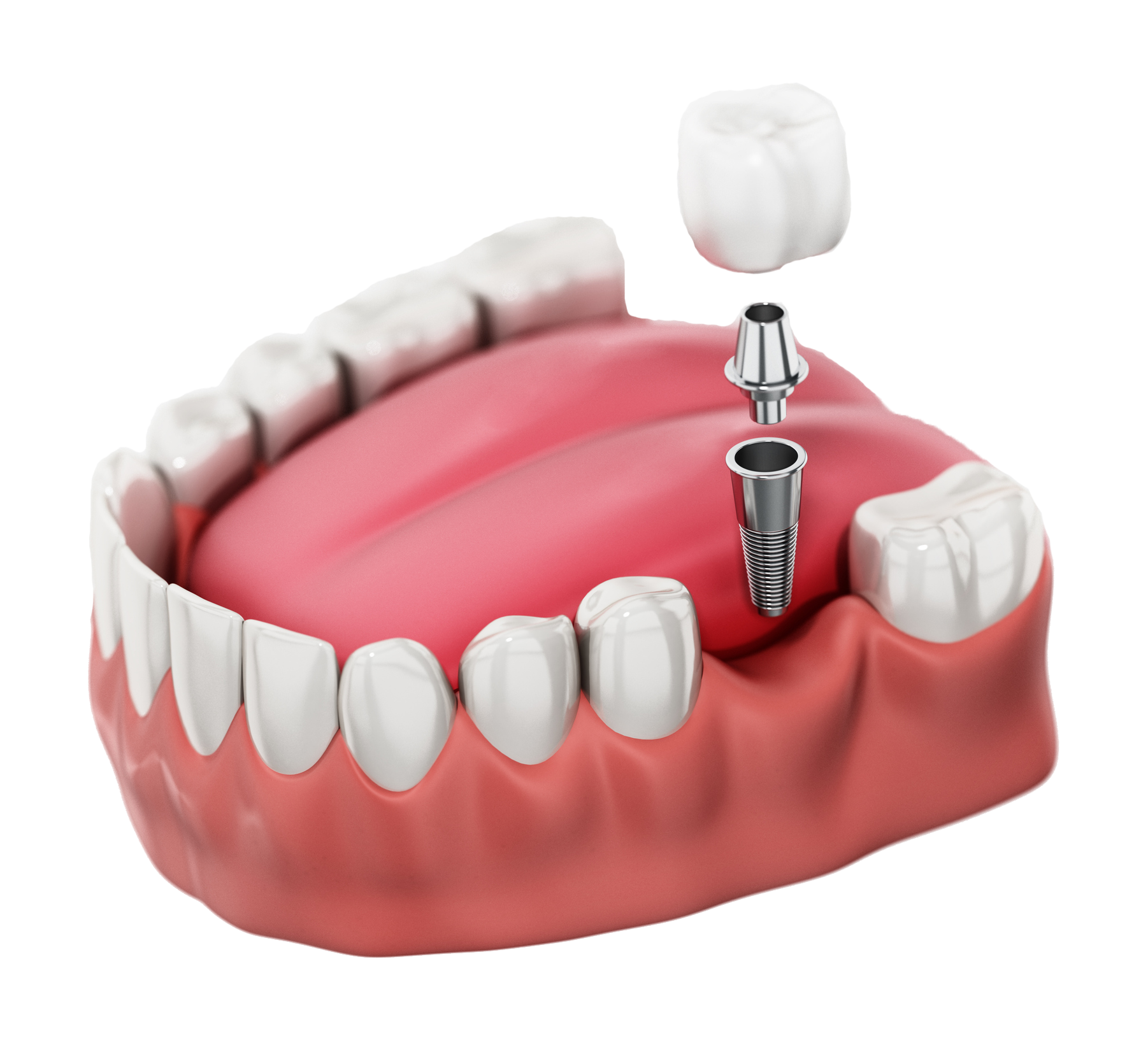 Single Implant
