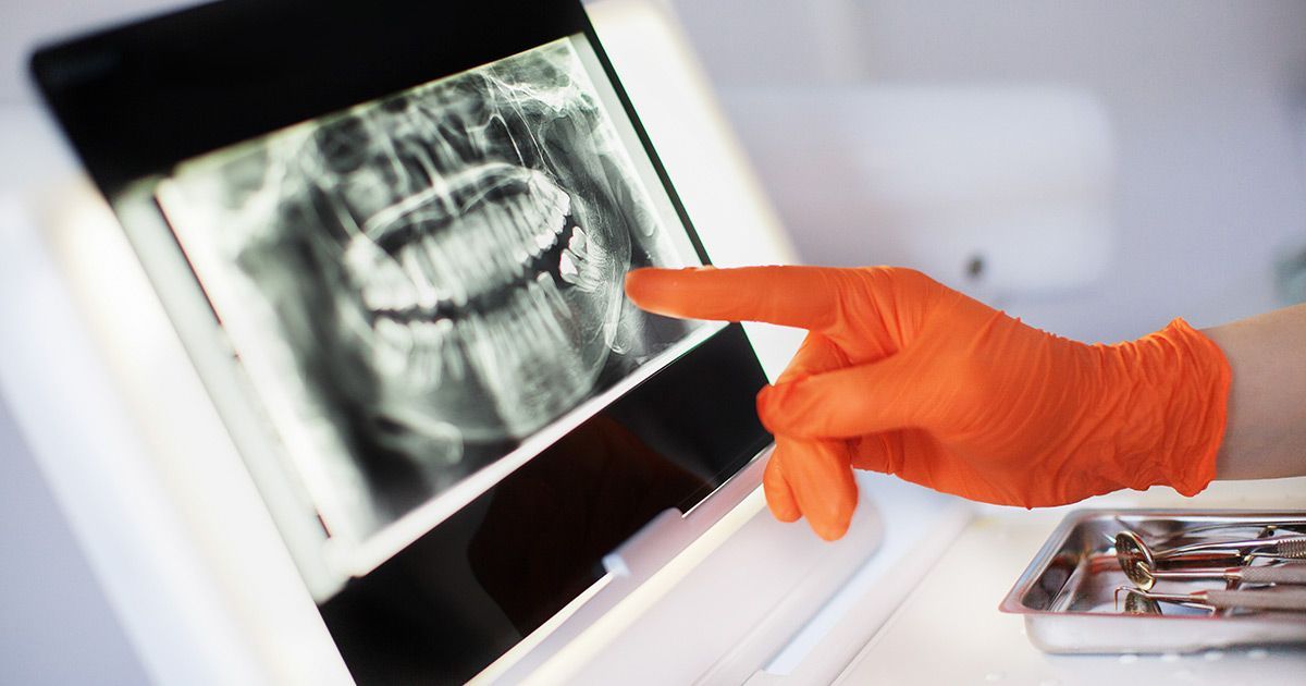 A dentist is pointing at an x-ray of a person 's teeth.