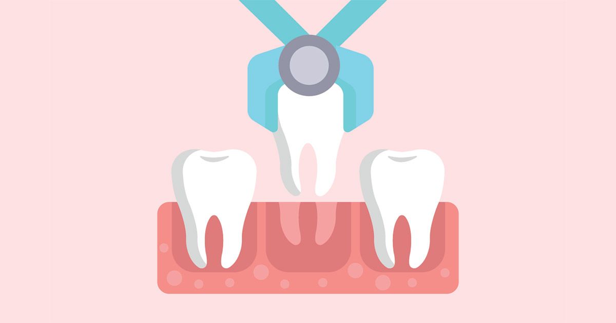 tooth extraction in San Diego