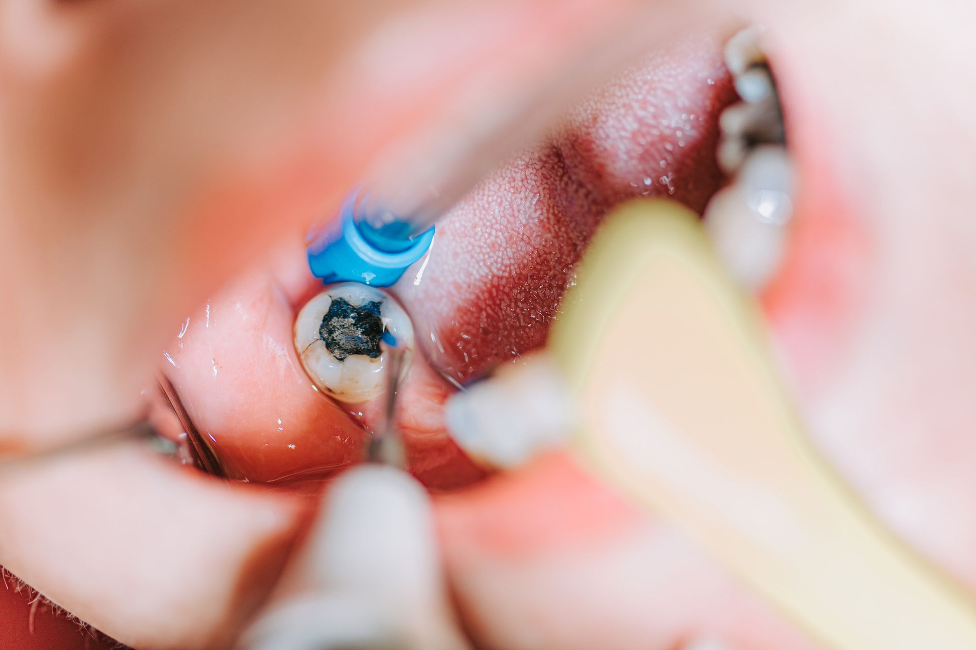 Dentist Examining Tooth Filling — Mount Waverley, VIC — Mount Waverley Dental