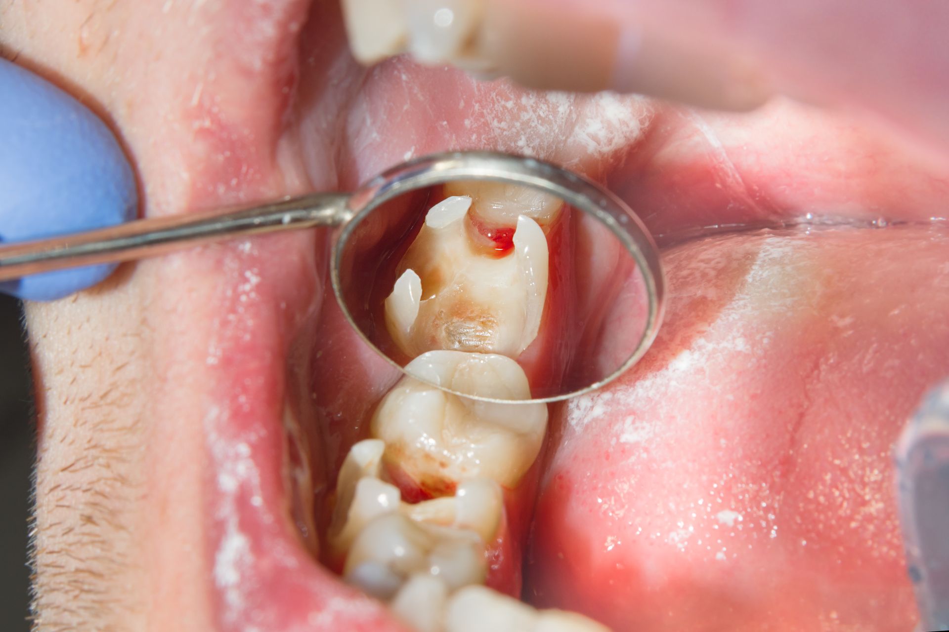 Close-Up of a Human Rotten Carious Tooth at the Treatment Stage — Mount Waverley, VIC — Mount Waverley Dental