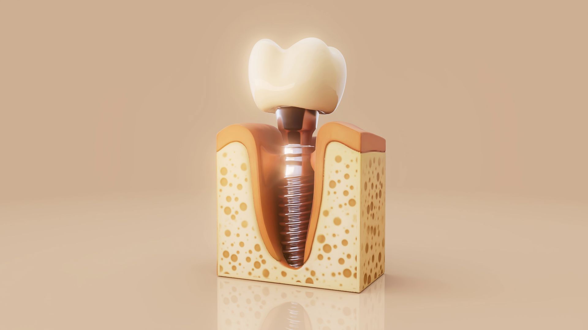 Tooth cross-section diagram showing decay inside a molar and a visible root canal