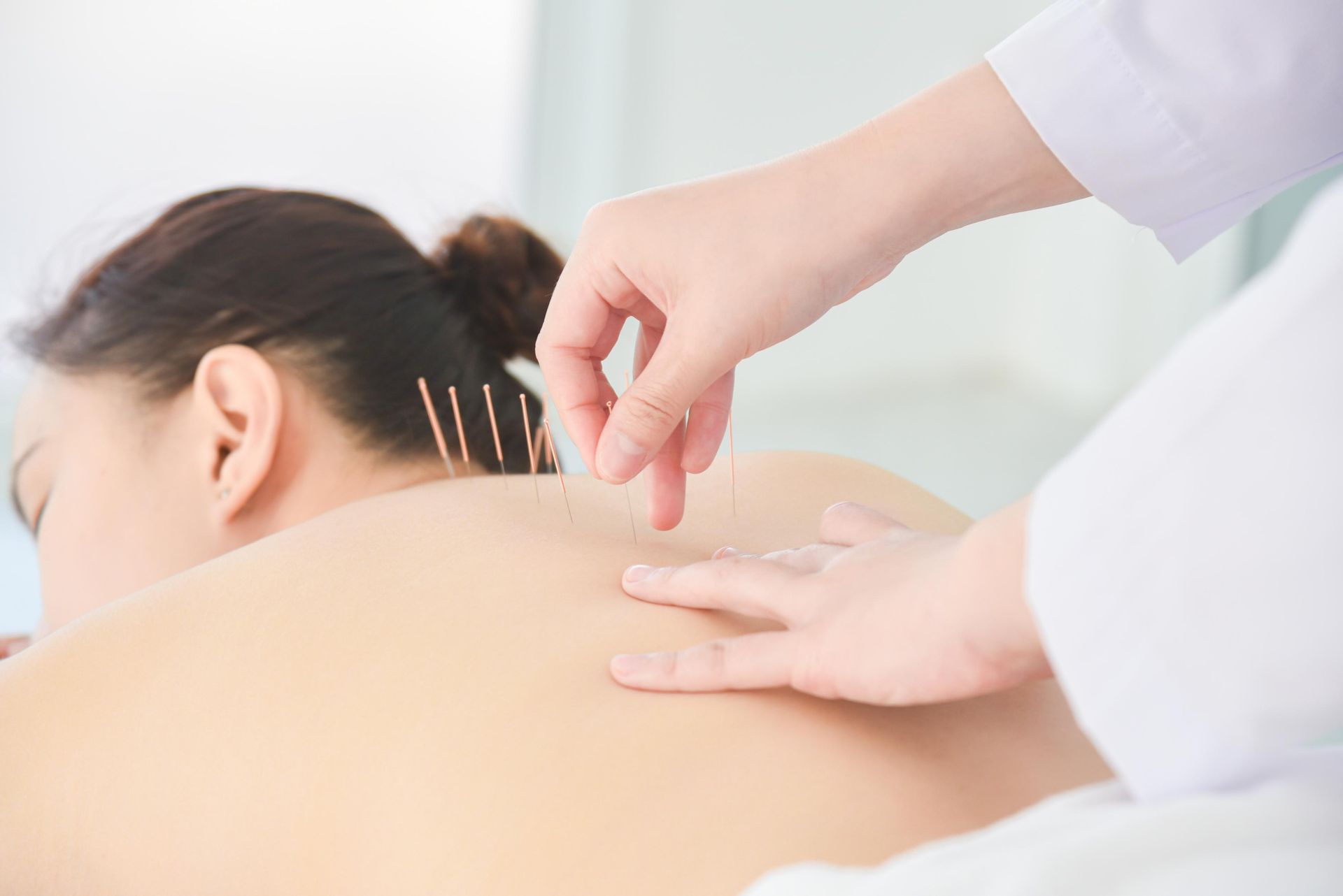 A Woman is Getting Acupuncture on Her Back by a Doctor — Scott Martin Acupuncture Mackay In Proserpine, QLD
