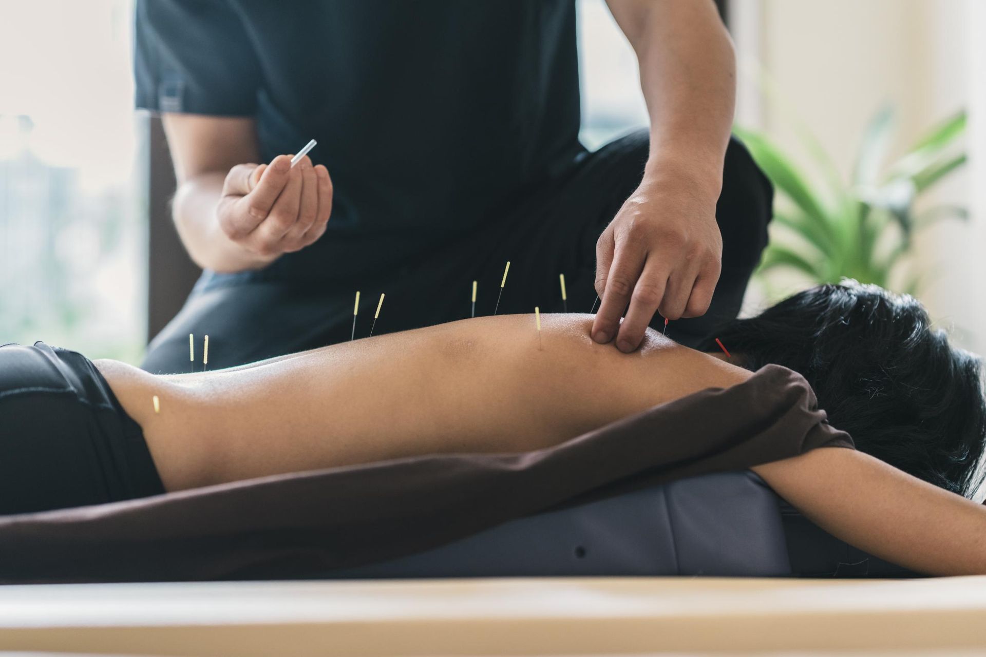 A Man is Giving an Acupuncture Treatment to a Woman — Scott Martin Acupuncture Mackay In Proserpine, QLD