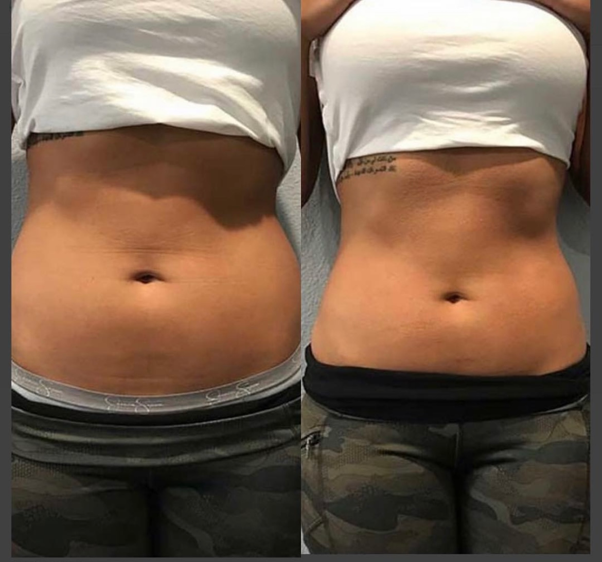 cryolipolysis before after
