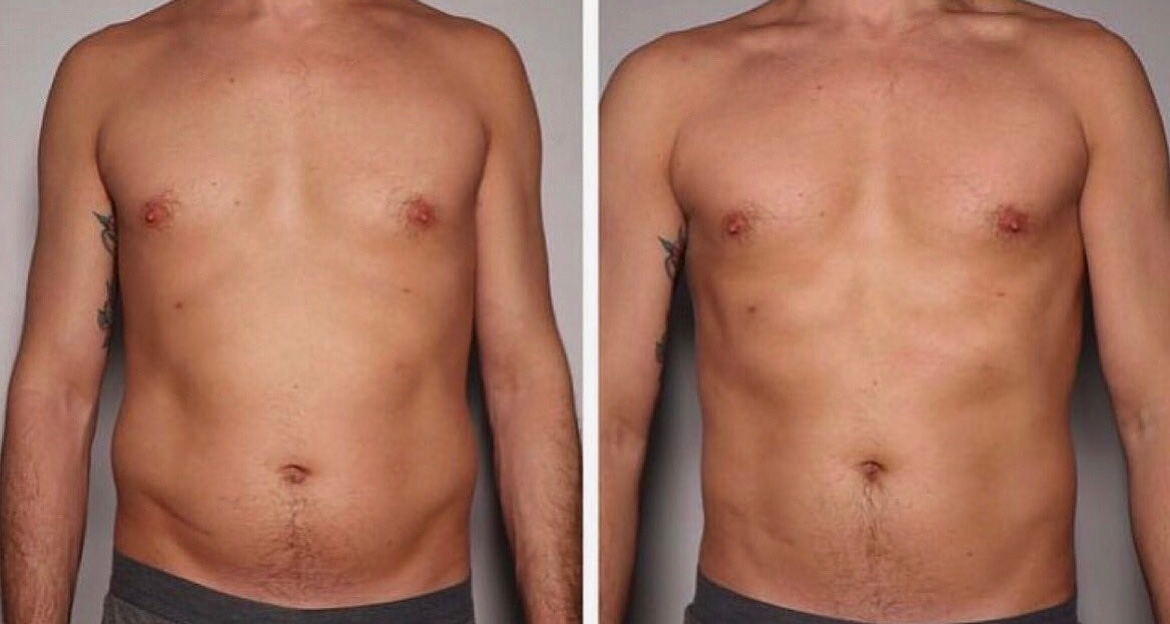 cryolipolysis before after treatment
