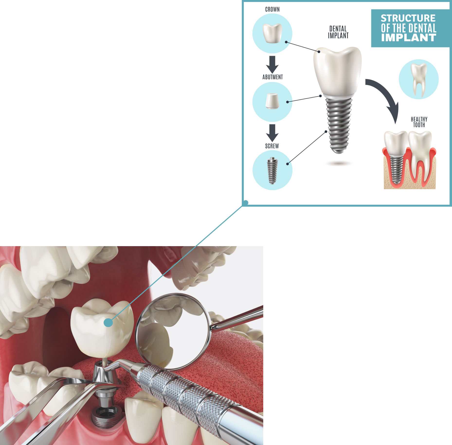 How Long Does It Take to Get Dental Implants from Start to Finish