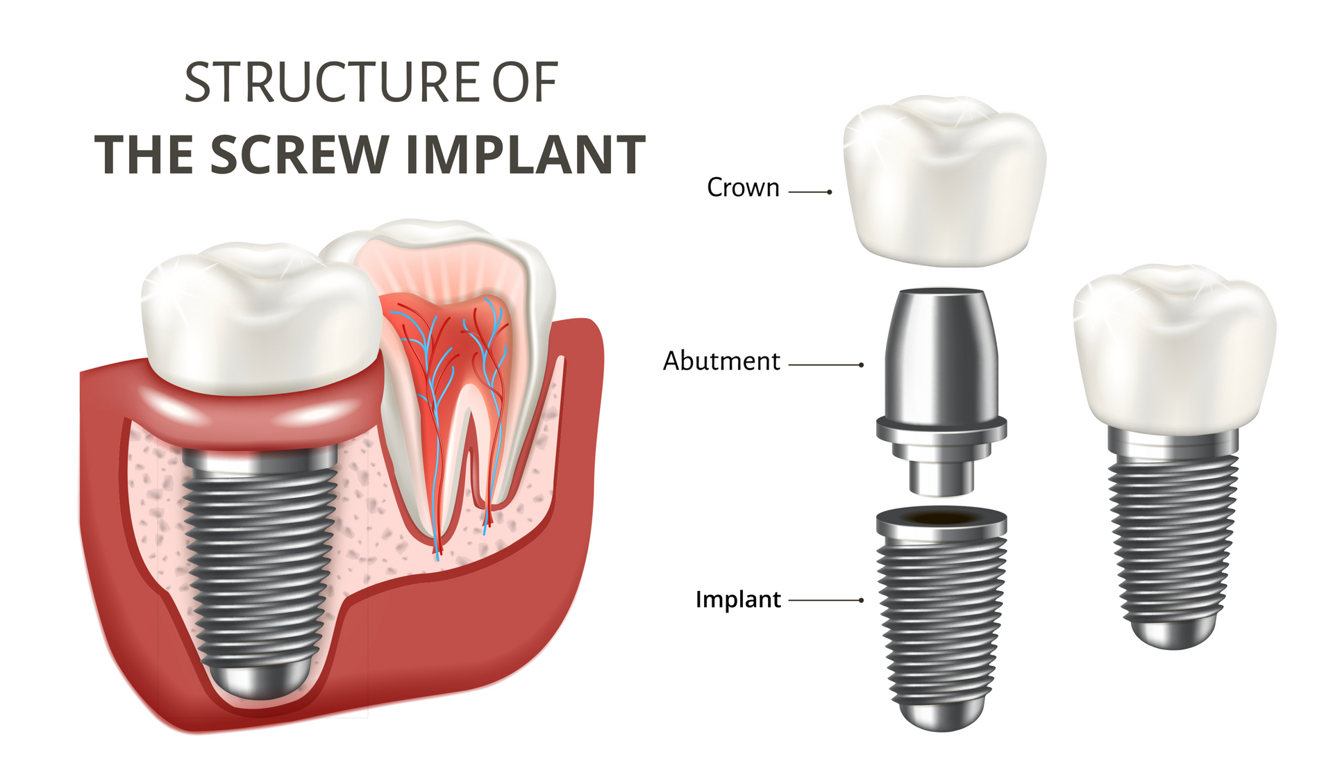 Dental implants procedures in Rolling Hills Estates, California