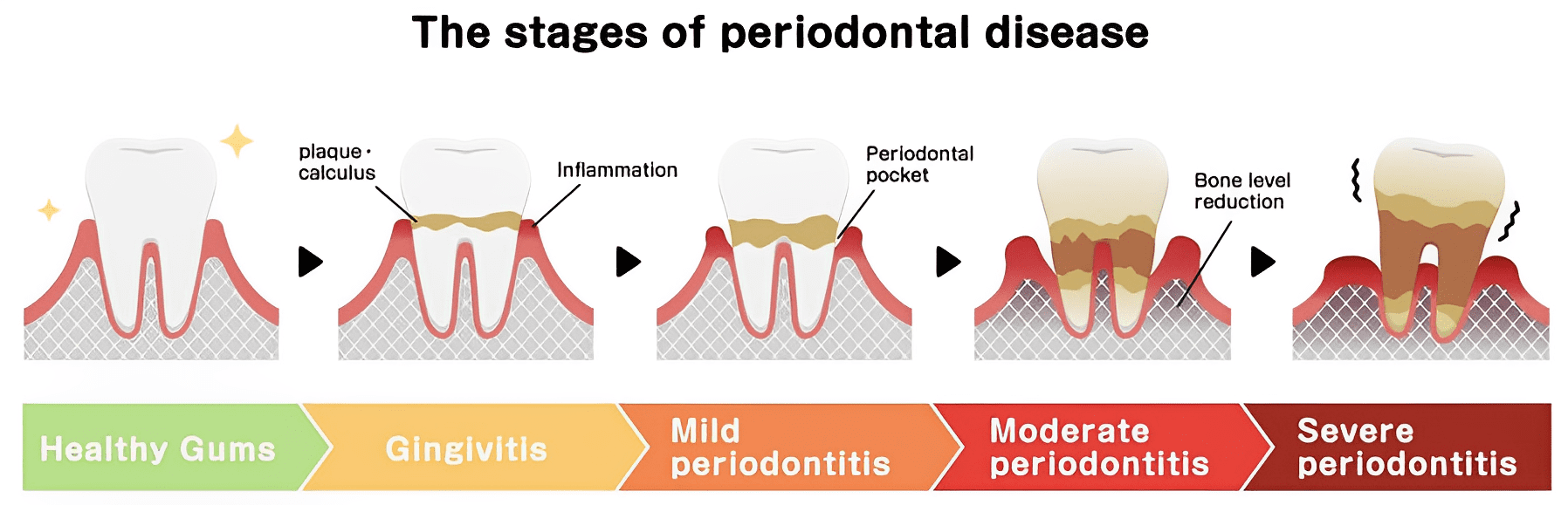 Gum Disease in Rolling Hills Estates, California