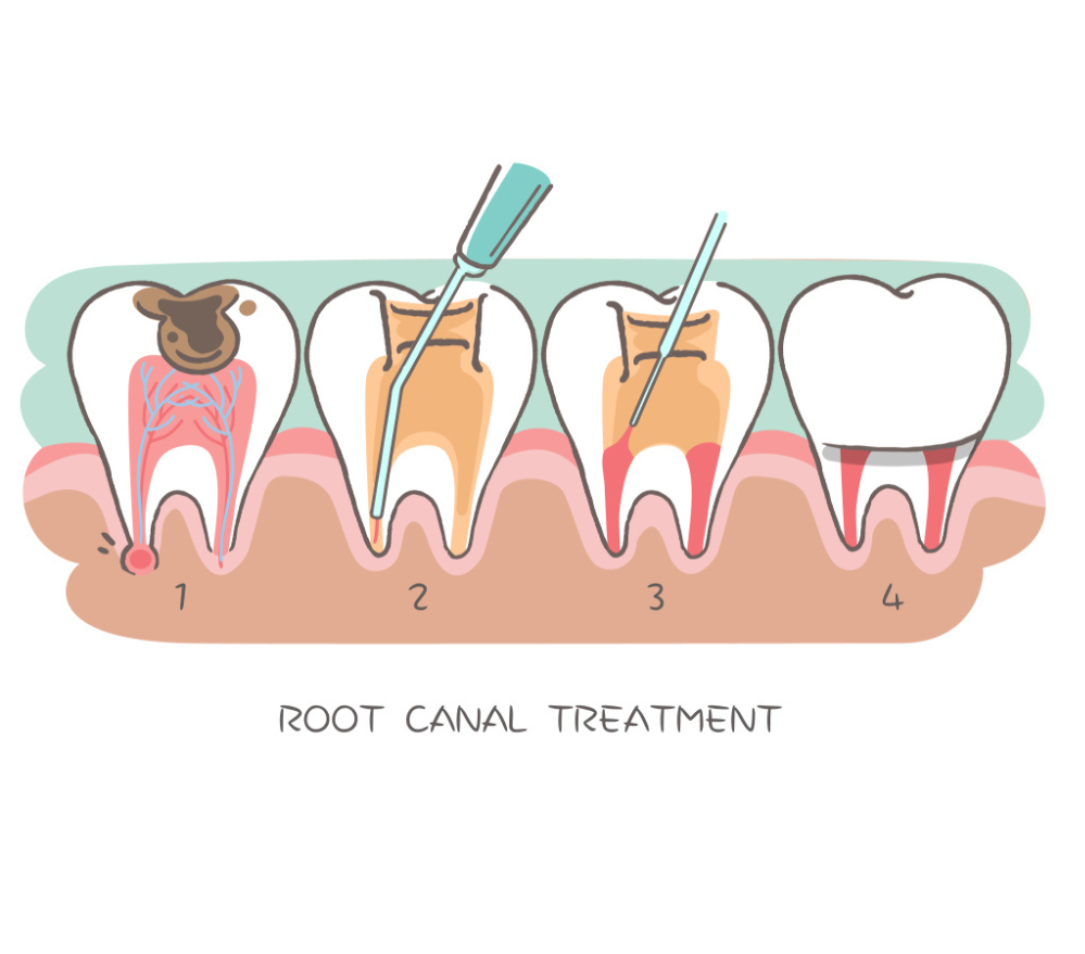 Root Canal