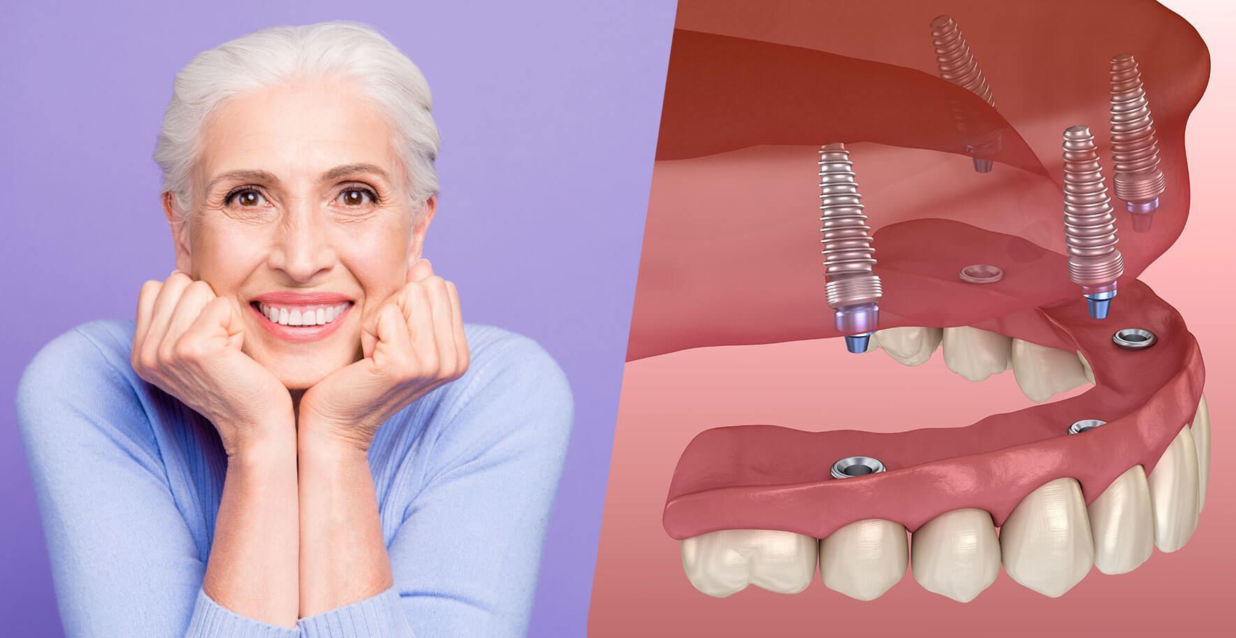 Understanding Full Mouth Dental Implants and costs