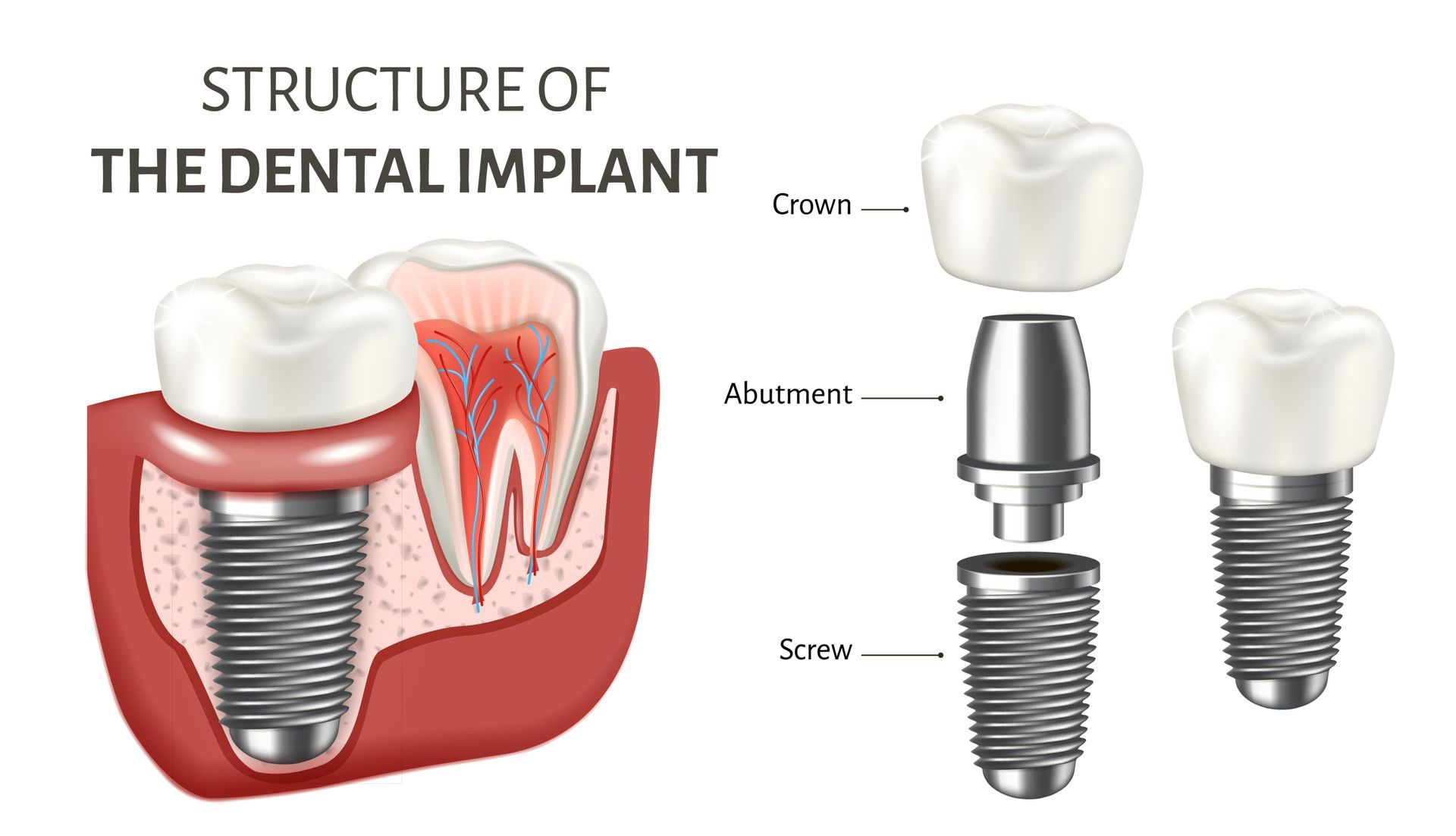 Dental implants procedures in Rolling Hills Estates, California
