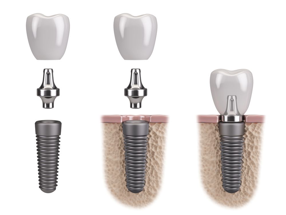 Dental Implants Process